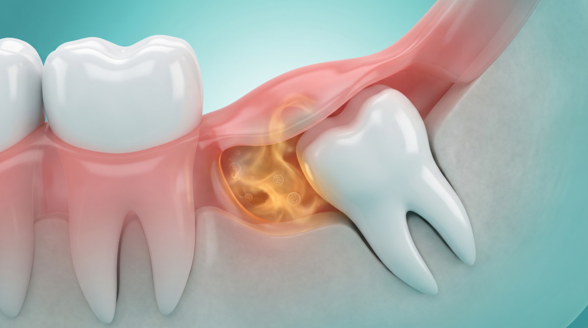 Medical illustration of a gum flap (operculum) over a wisdom tooth trapping odor-causing bacteria in a dental pocket.