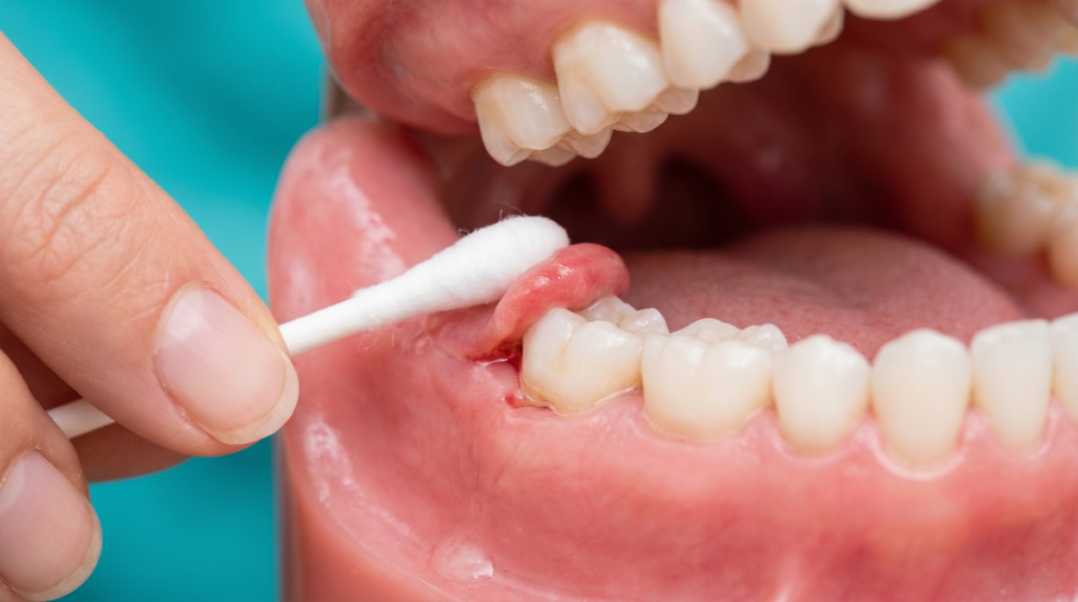 A dental model demonstrating the 10-second Q-tip test to identify odor from a wisdom tooth gum flap.